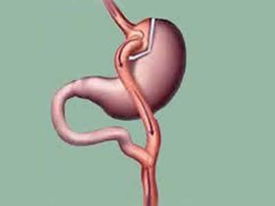 bypass gastrico RIOBAMBA