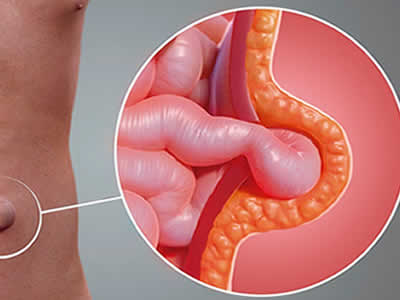 HERNIAS RIOBAMBA